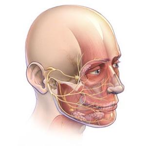 neuritis del nervio facial